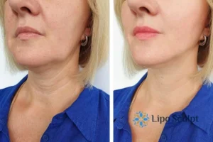 Double chin before and after Hi-Fu treatment 4 Book your double chin treatment Earley today! We are here to help!