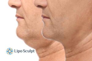 Double chin before and after Hi-Fu treatment 2 Double chin treatment Earley from Lipo Sculpt - feel more confident today!