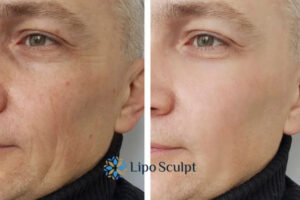 How to Fight Aging Symptoms 3 Fight Aging Symptoms Earley With HIFU and Morpheus8 Today!