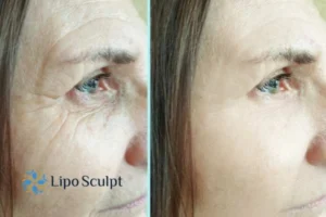 How to Fight Aging Symptoms 2 Do you want to Fight Aging Symptoms Earley? Contact Lipo Sculpt today!