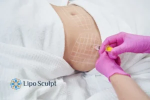 Are The Results From Aqualyx Permanent? 1 Do you want to know how long Aqualyx Earley results last?