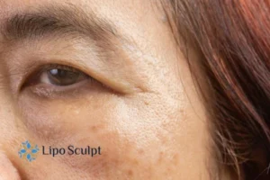 Cryopen: The Revolutionary Treatment for Age Spots Unveiled 2 Are age spots Earley giving you low self esteem? Contact us today!