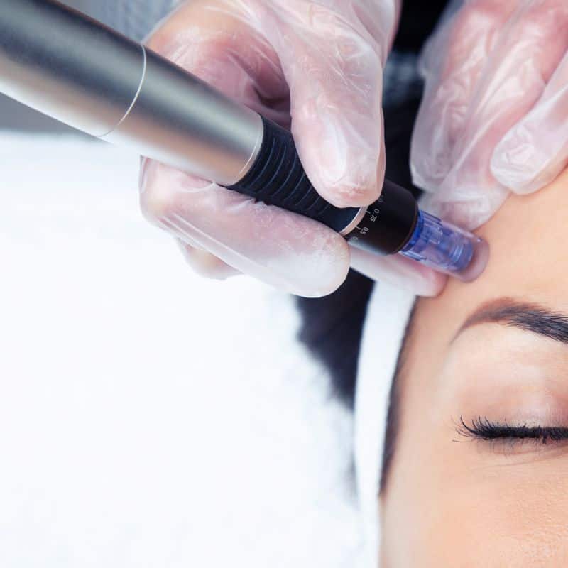 Morpheus8 treatment Earley from Lipo Sculpt - Book in today!