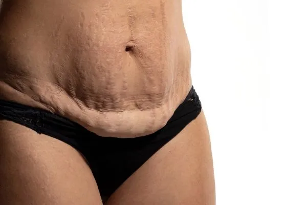 Lost the Weight but Not the Loose Skin? 1 image of womans stomach after weight loss showing loose skin Earley